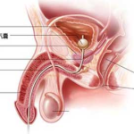 私密护理引发泌尿感染,预防与应对策略